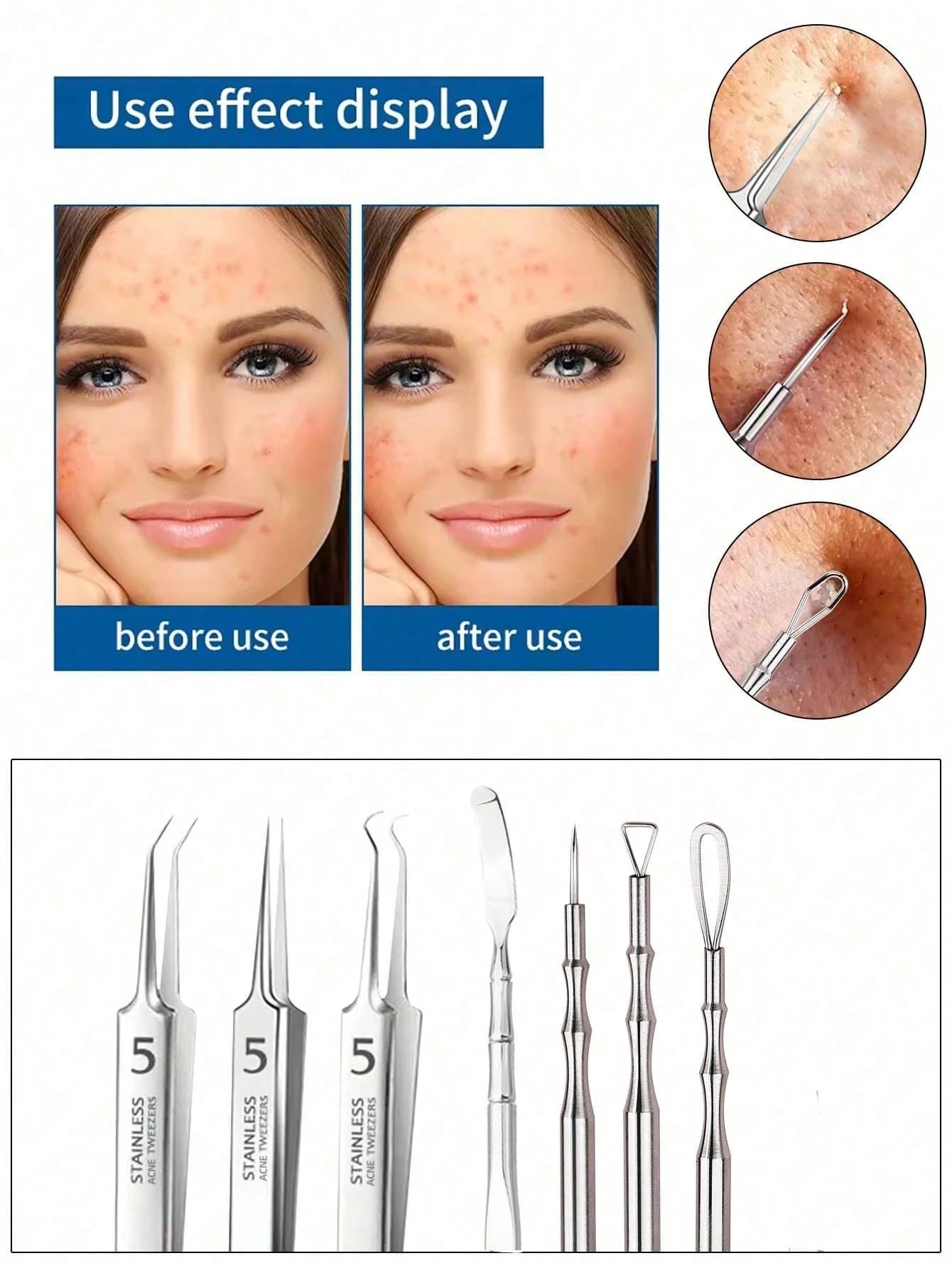 1/4/5/7pcs Acne & Blackhead Removal Needle Set, Stainless Steel Pimple & Blemish Extractor, Deep Cleansing Facial Skincare Tool Kit